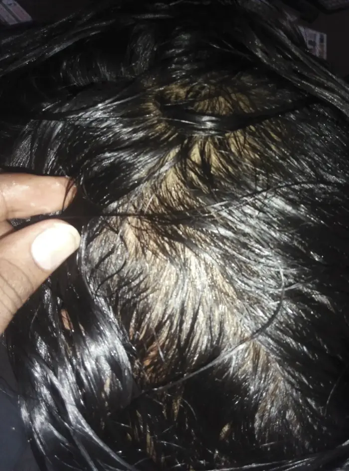 Alopecia Areata case 5 after treatment